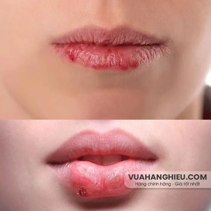 17+ cách trị môi khô bong tróc nứt nẻ hiệu quả sau 1 đêm
