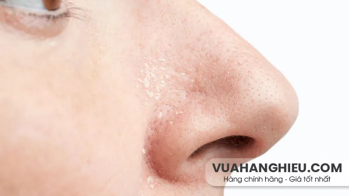 10 cách chăm sóc da khô xung quanh mũi hiệu quả nhanh chóng
