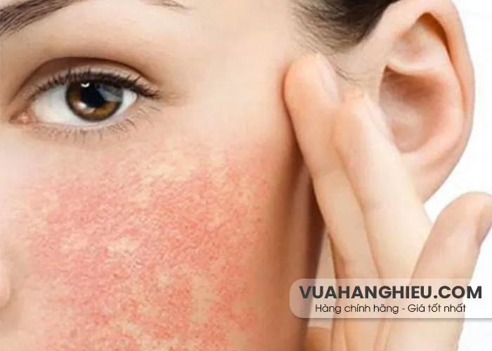 Cách chăm sóc da sau laser giúp da nhanh phục hồi
