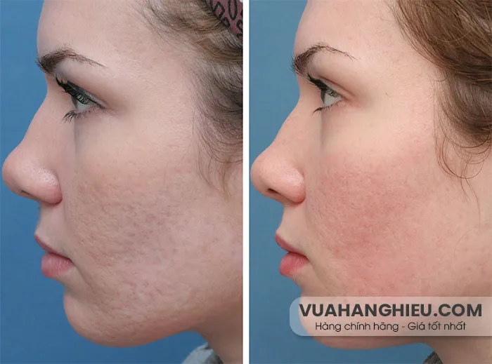 9 loại serum trị sẹo rỗ giúp làm đầy, tái tạo da mặt được nhiều khách hàng yêu thích   - 2