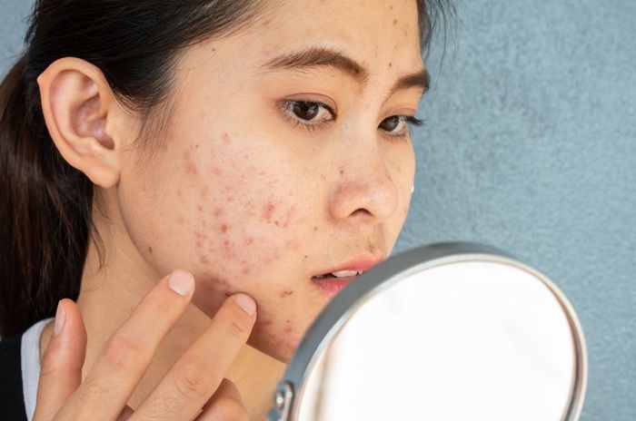Cách hỗ trợ làm sạch mụn khi mang thai thân thiện với làn da và hiệu quả được bác sĩ khuyên dùng