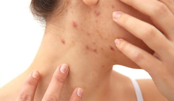 Cách hỗ trợ làm sạch mụn khi mang thai thân thiện với làn da và hiệu quả được bác sĩ khuyên dùng