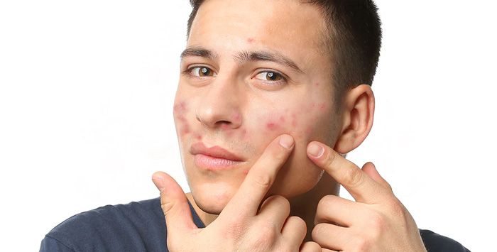 Top 10 kem hỗ trợ làm sạch mụn cho nam giới hiệu quả và được nhiều khách hàng yêu thích hiện nay  - 2