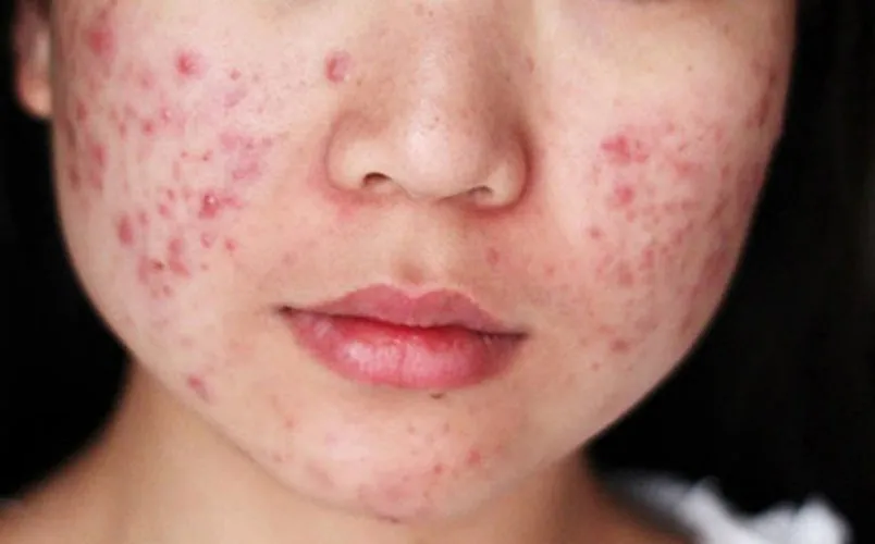 Cách phân biệt các loại mụn dễ bắt gặp trên da