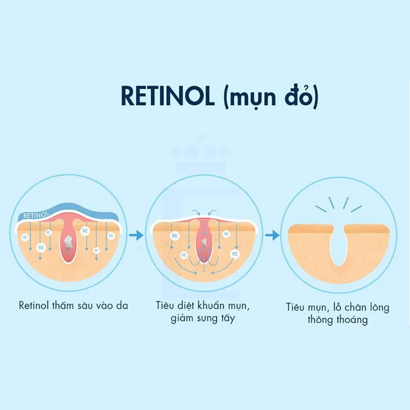Cách phân biệt các loại mụn dễ bắt gặp trên da