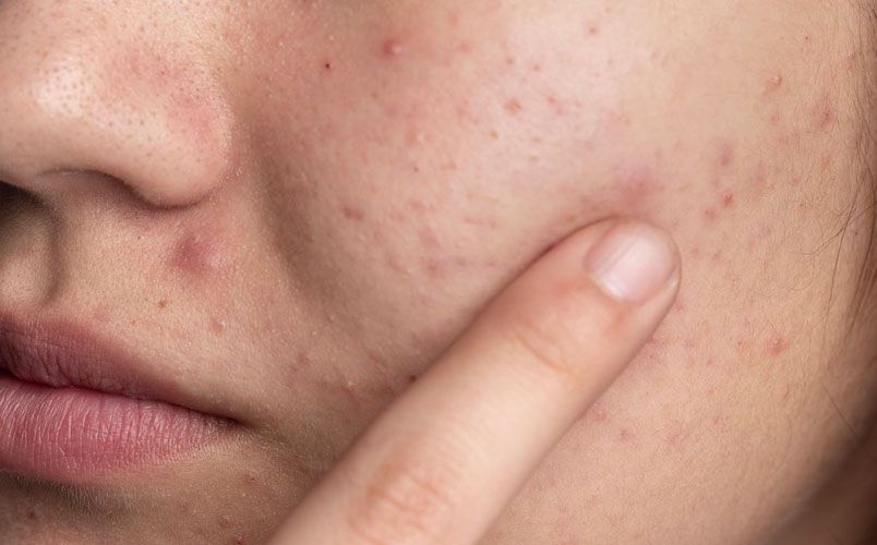 Cách phân biệt các loại mụn dễ bắt gặp trên da