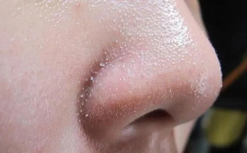 Cách phân biệt các loại mụn dễ bắt gặp trên da