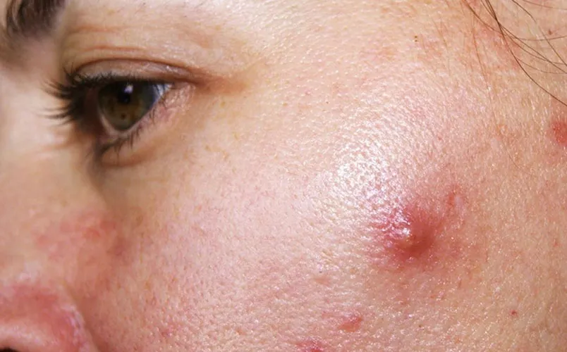 Cách phân biệt các loại mụn dễ bắt gặp trên da