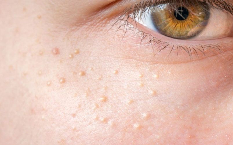 Cách phân biệt các loại mụn dễ bắt gặp trên da