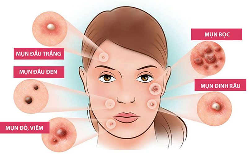 Cách phân biệt các loại mụn dễ bắt gặp trên da