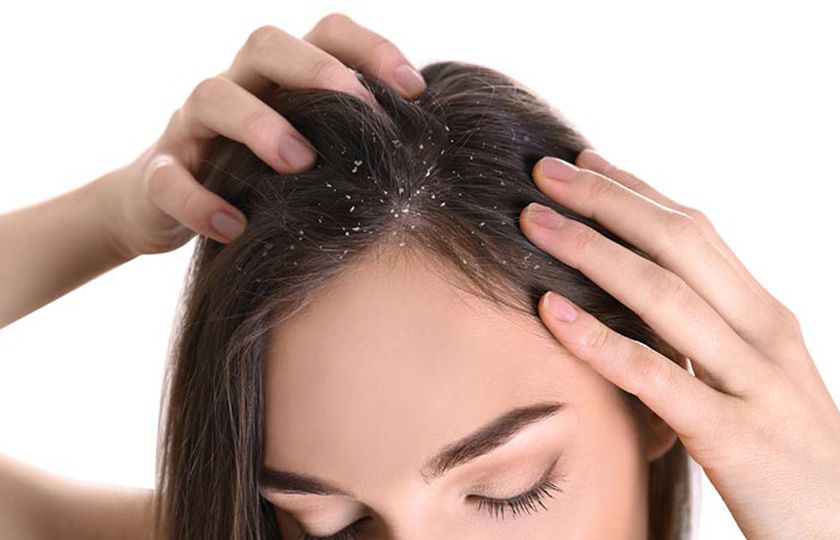 30 cách trị gàu tại nhà giúp cải thiện đáng kể điểm nhanh từ nguyên liệu thiên nhiên