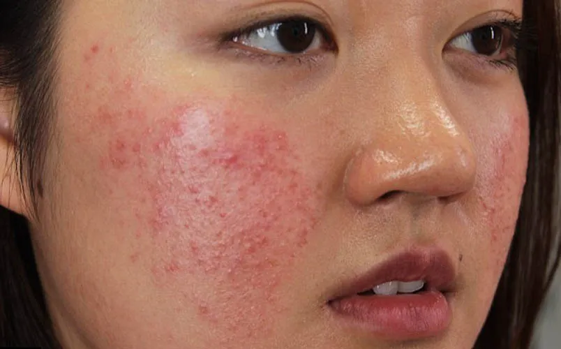 Hạn sử dụng kem chống nắng Anessa và những điều cần biết