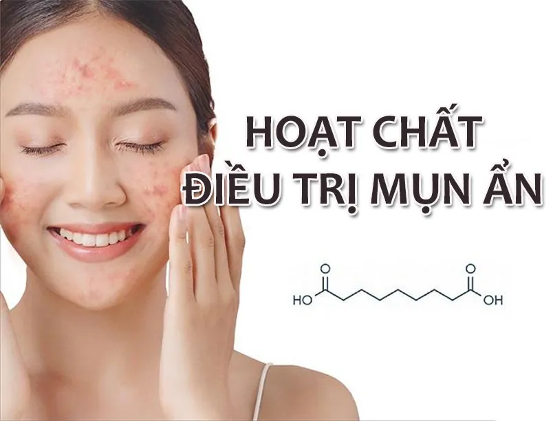 Top 5 hoạt chất hỗ trợ làm sạch mụn ẩn được Bác sĩ da liễu khuyên dùng  - 6
