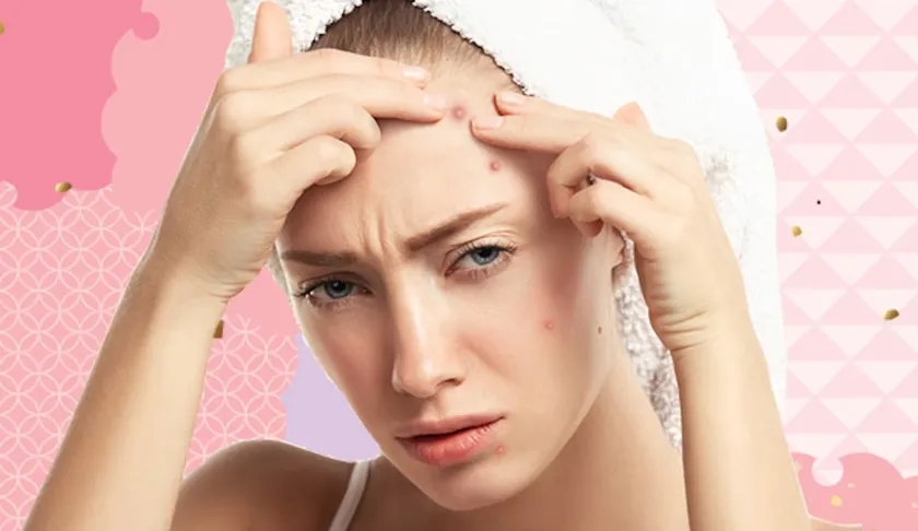 Mụn trên trán: Nguyên nhân và cách hỗ trợ cải thiện hiệu quả từ chuyên gia