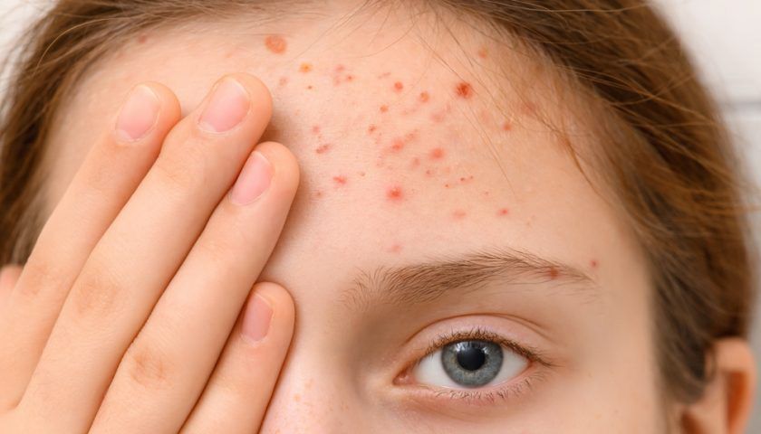 Mụn trên trán: Nguyên nhân và cách hỗ trợ cải thiện hiệu quả từ chuyên gia