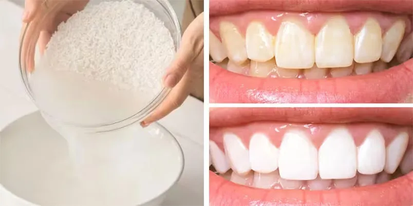 13 cách làm trắng răng tại nhà thân thiện với làn da, siêu tiết kiệm