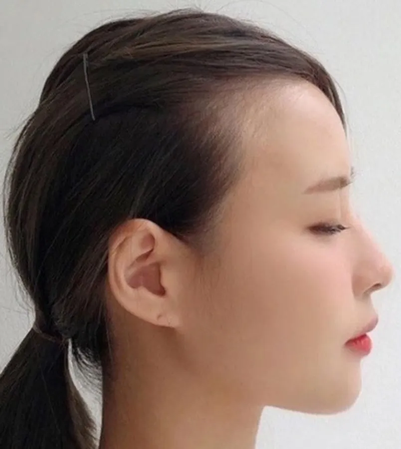 10+ kiểu tóc cho người hói chữ M nữ vô cùng đẹp