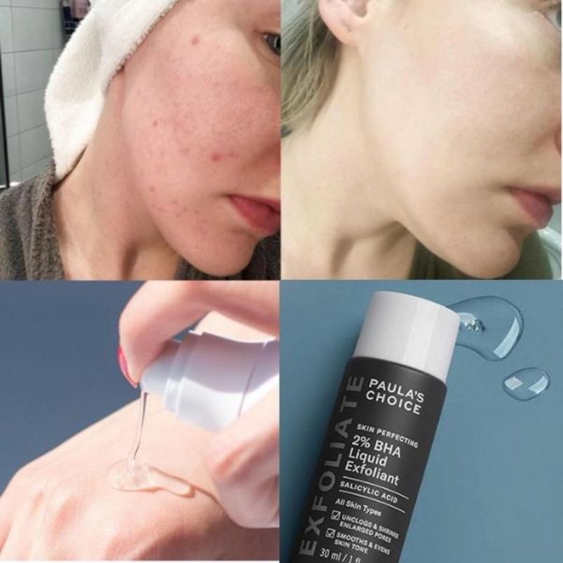 Các bước skincare cho tuổi dậy thì đơn giản, hiệu quả