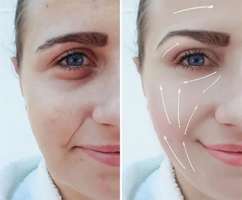 11 cách giảm nếp nhăn rãnh cười trên khuôn mặt hiệu quả - 1