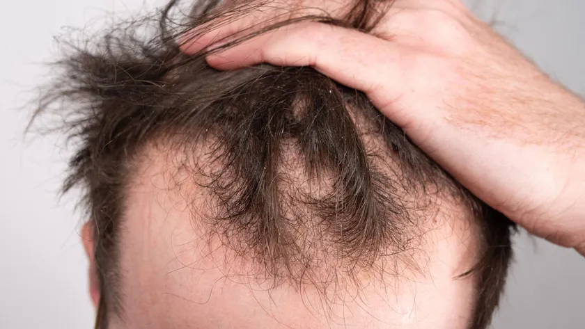 Nguyên nhân rụng tóc ở nam giới và 9 cách khắc phục hiệu quả