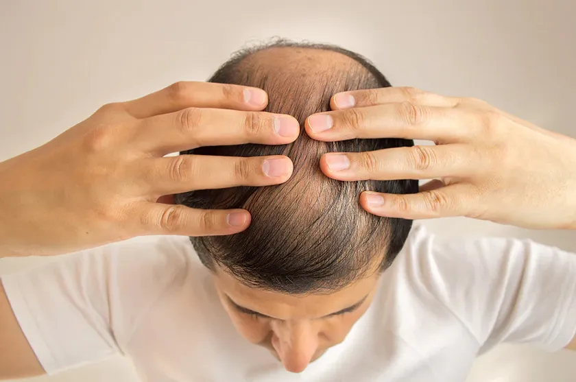 Nguyên nhân rụng tóc ở nam giới và 9 cách khắc phục hiệu quả