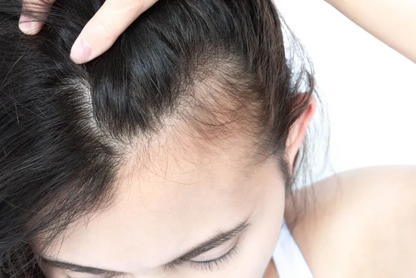 Rụng tóc sau sinh là gì? 13 cách ngăn ngừa tóc rụng cho mẹ bỉm sữa
