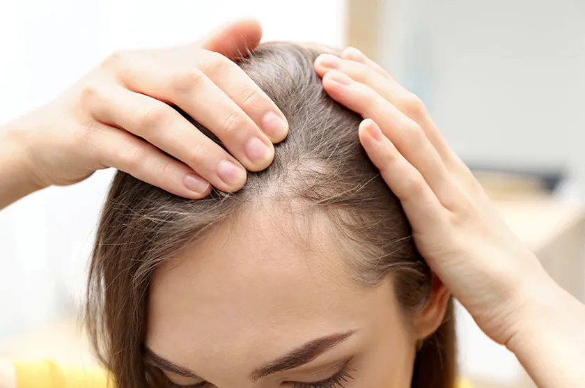 Rụng tóc sau sinh là gì? 13 cách ngăn ngừa tóc rụng cho mẹ bỉm sữa