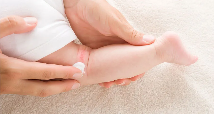 Top 12 kem dưỡng ẩm cho bé bị viêm da cơ địa được nhiều khách hàng yêu thích cho mẹ tham khảo