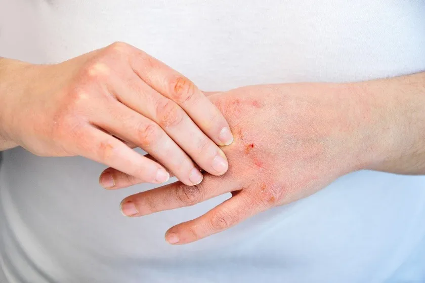 10 cách trị da tay bị khô nẻ vào mùa đông hiệu quả