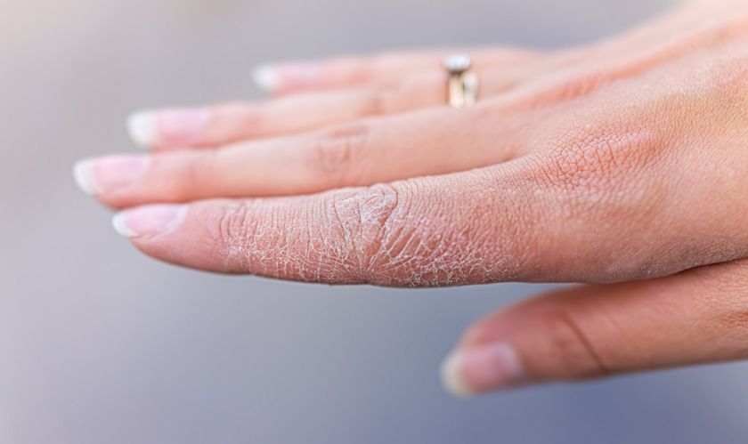 10 cách trị da tay bị khô nẻ vào mùa đông hiệu quả