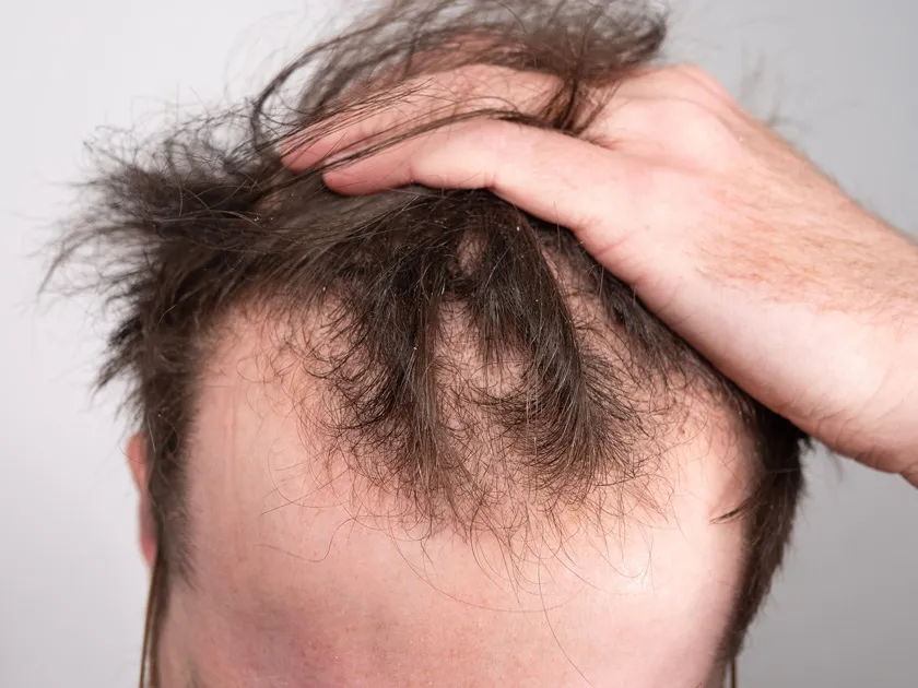 Top 11 dầu gội ngăn rụng tóc cho nam được yêu thích hiện nay