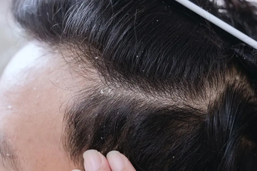 Top 10 dầu gội trị gàu cho nam hiệu quả được đánh giá cao