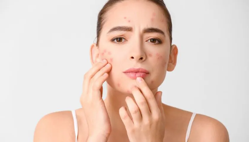 Bầu có dùng kem hỗ trợ làm sạch mụn được không? Top 5 kem hỗ trợ làm sạch mụn cho bà bầu thân thiện với làn da - 1