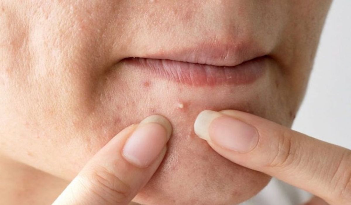 Không nặn mụn có tự hết không? Hướng dẫn cách tự nặn mụn an toàn