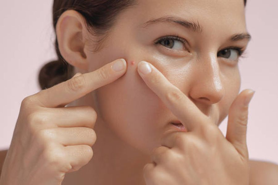 Nặn mụn xong nên làm gì? Hướng dẫn các bước chăm sóc da sau nặn mụn uy tín