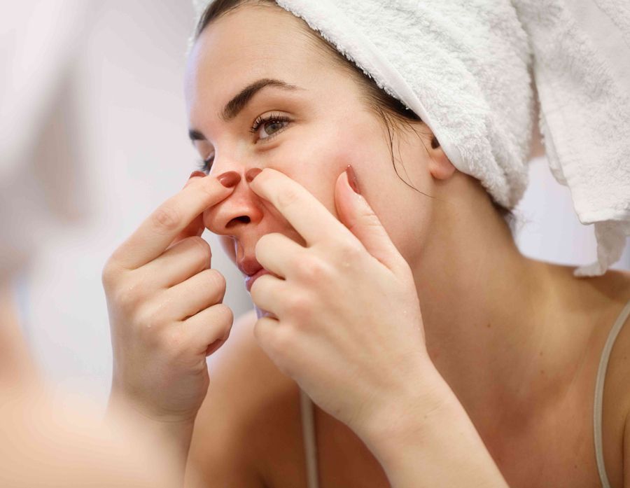 Nặn mụn xong nên làm gì? Hướng dẫn các bước chăm sóc da sau nặn mụn uy tín