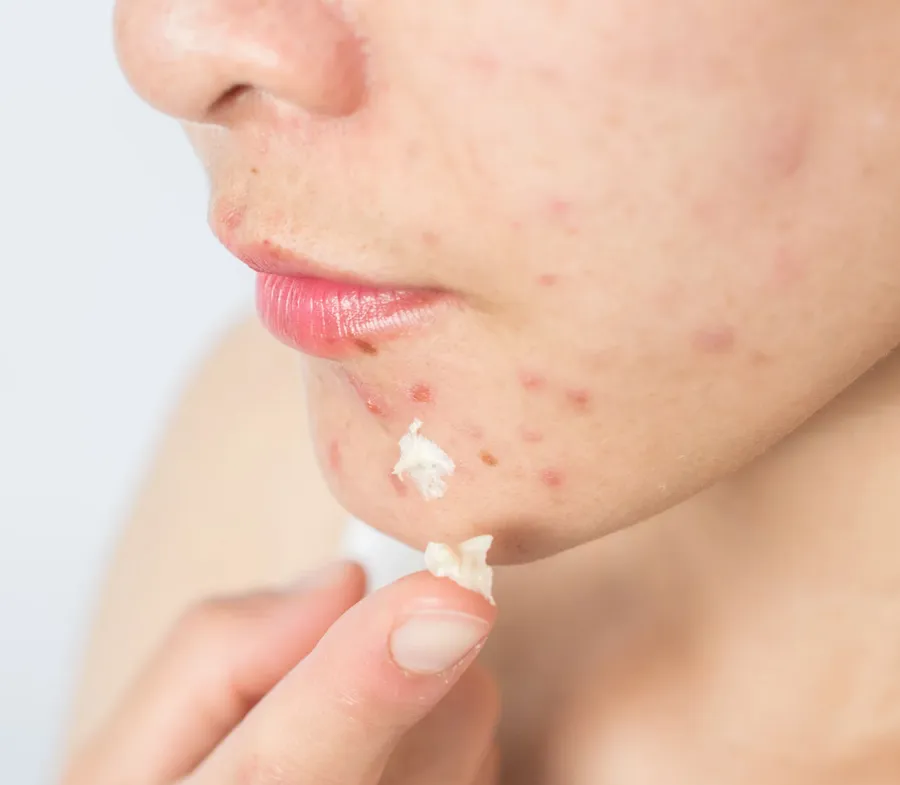 Nặn mụn xong nên làm gì? Hướng dẫn các bước chăm sóc da sau nặn mụn uy tín