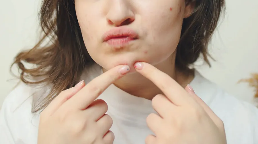 Da bị đẩy mụn