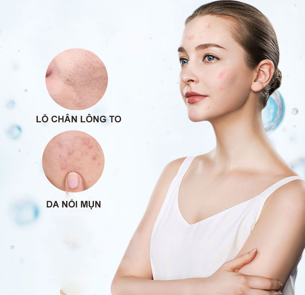 Da mụn có nên dùng kem chống nắng hay không?