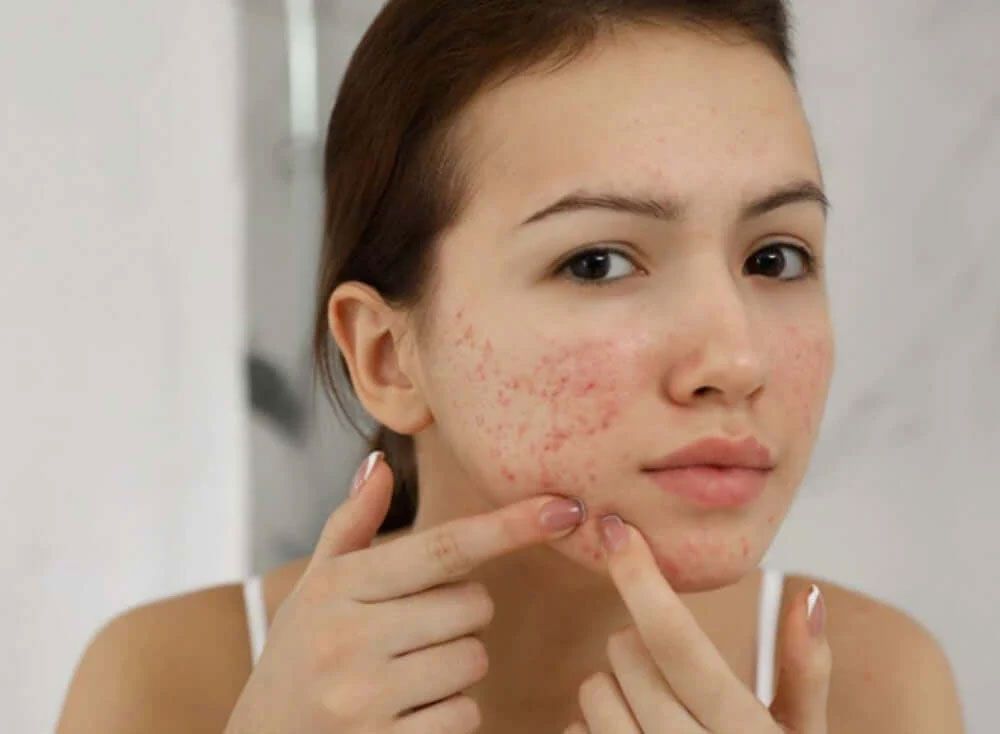 Da mụn có nên dùng kem chống nắng hay không?