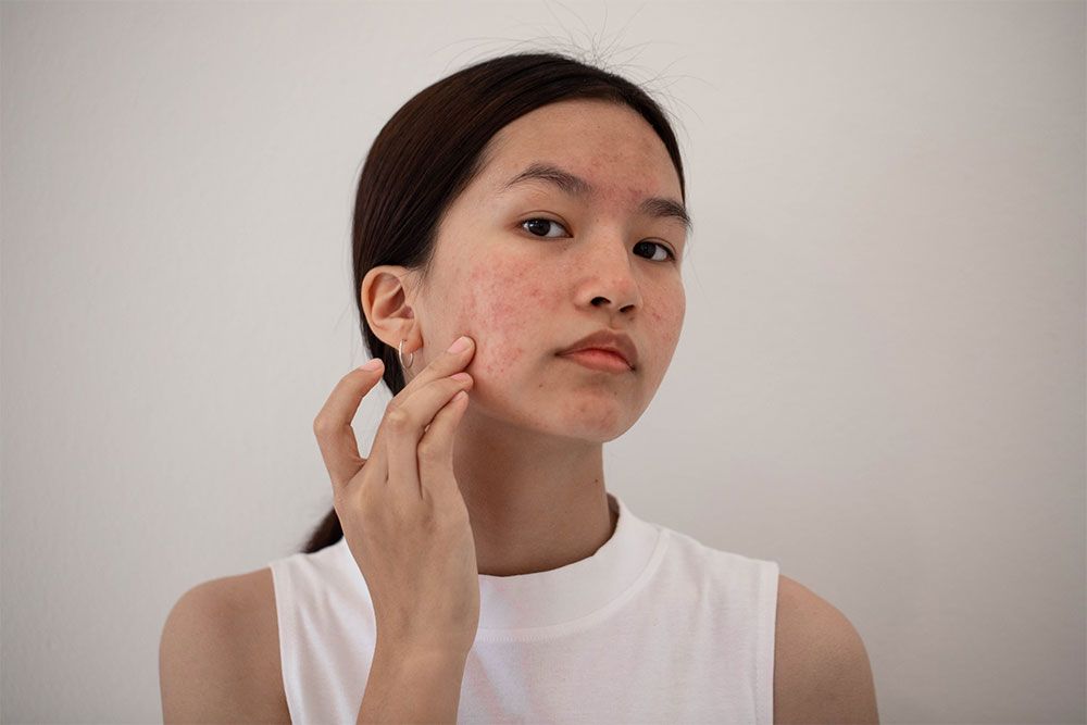 Da mụn có nên dùng kem chống nắng hay không?