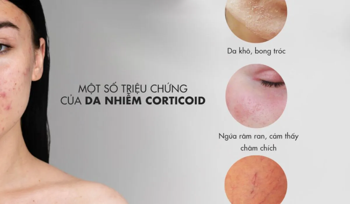 Da nhiễm corticoid: Dấu hiệu, nguyên nhân và cách phục hồi - 1