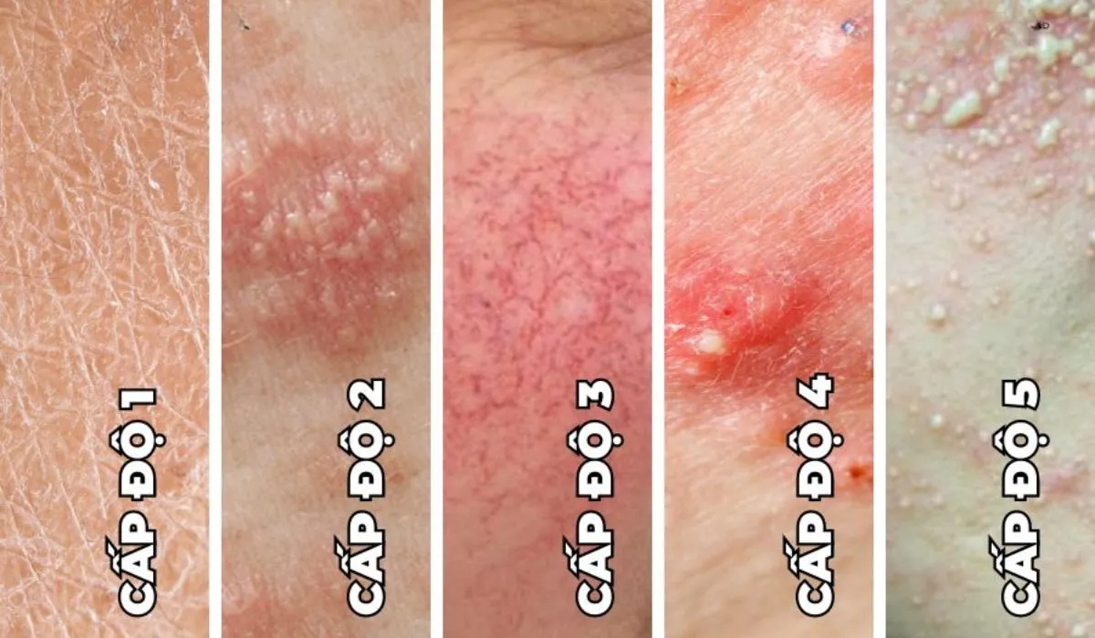 Da nhiễm corticoid: Dấu hiệu, nguyên nhân và cách phục hồi - 3