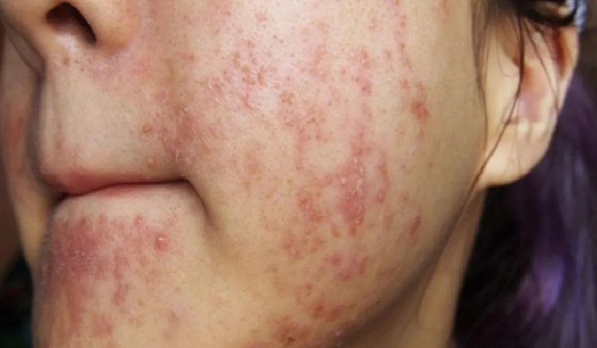 Da nhiễm corticoid: Dấu hiệu, nguyên nhân và cách phục hồi - 4