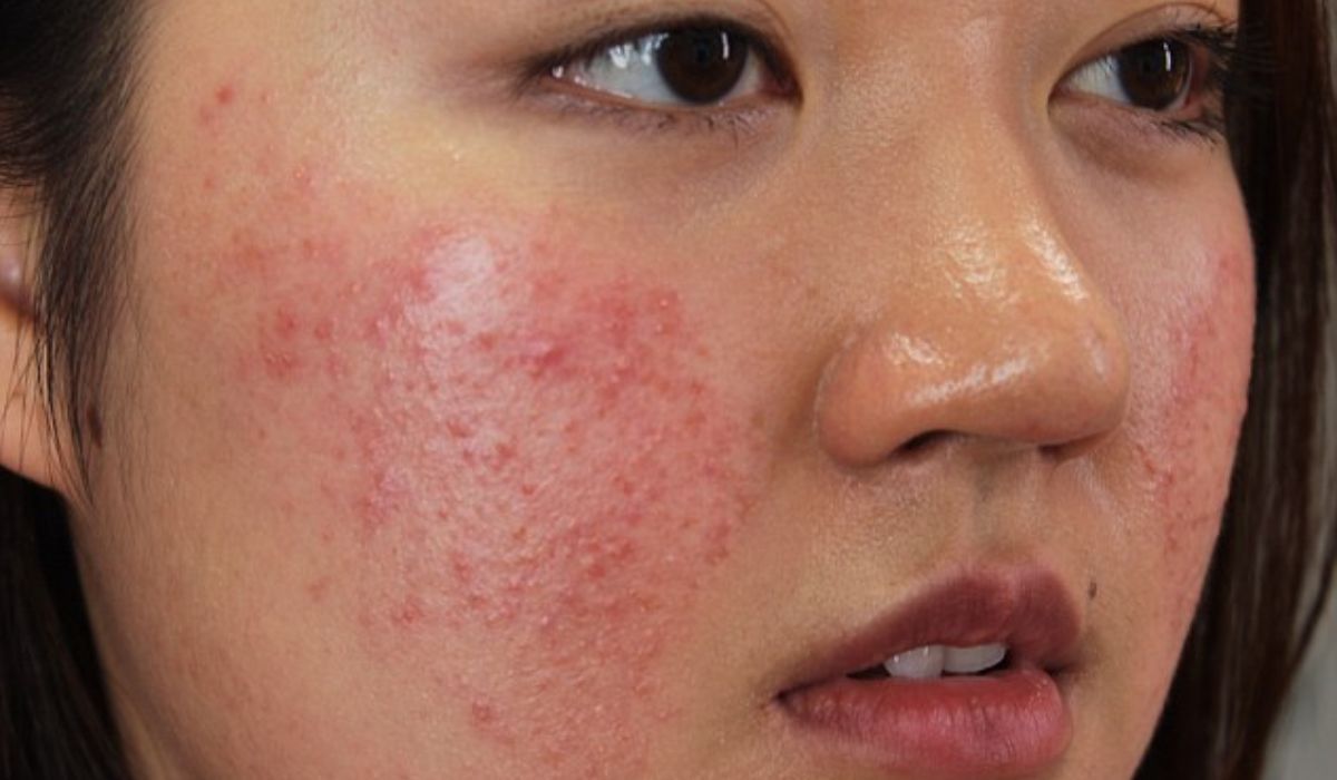 Dấu hiệu dị ứng mỹ phẩm bạn nổi trội định phải chú ý
