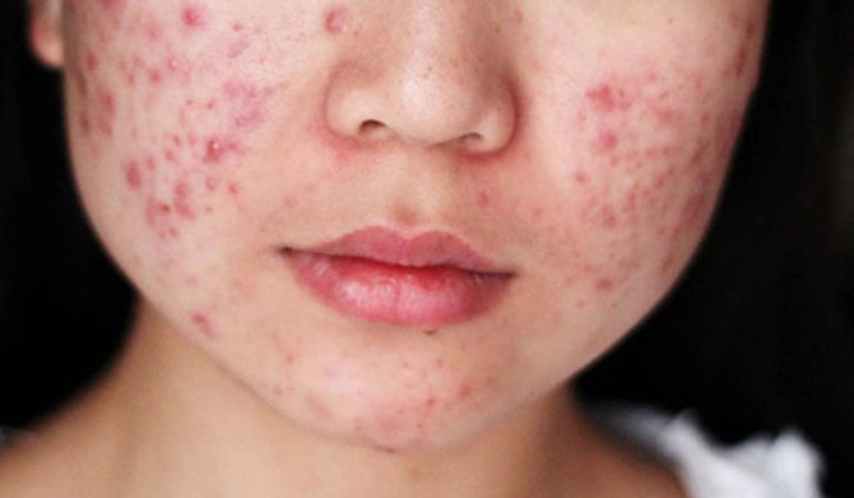 Dấu hiệu dị ứng mỹ phẩm bạn nổi trội định phải chú ý