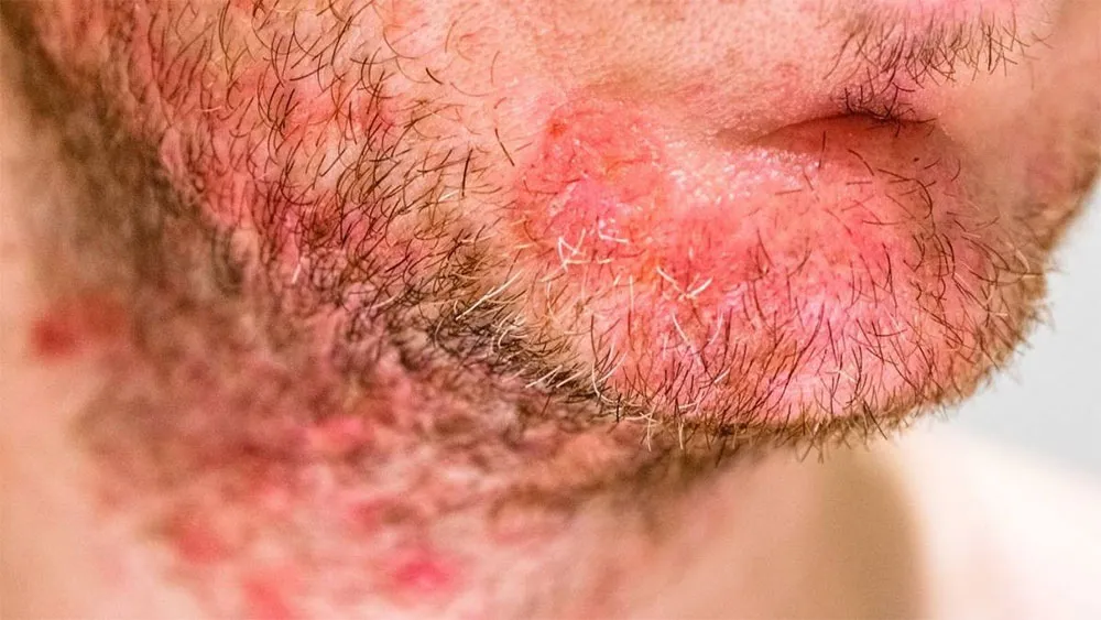 Tại sao cạo râu bị nổi mụn? 10 điều nên tránh khi cạo râu