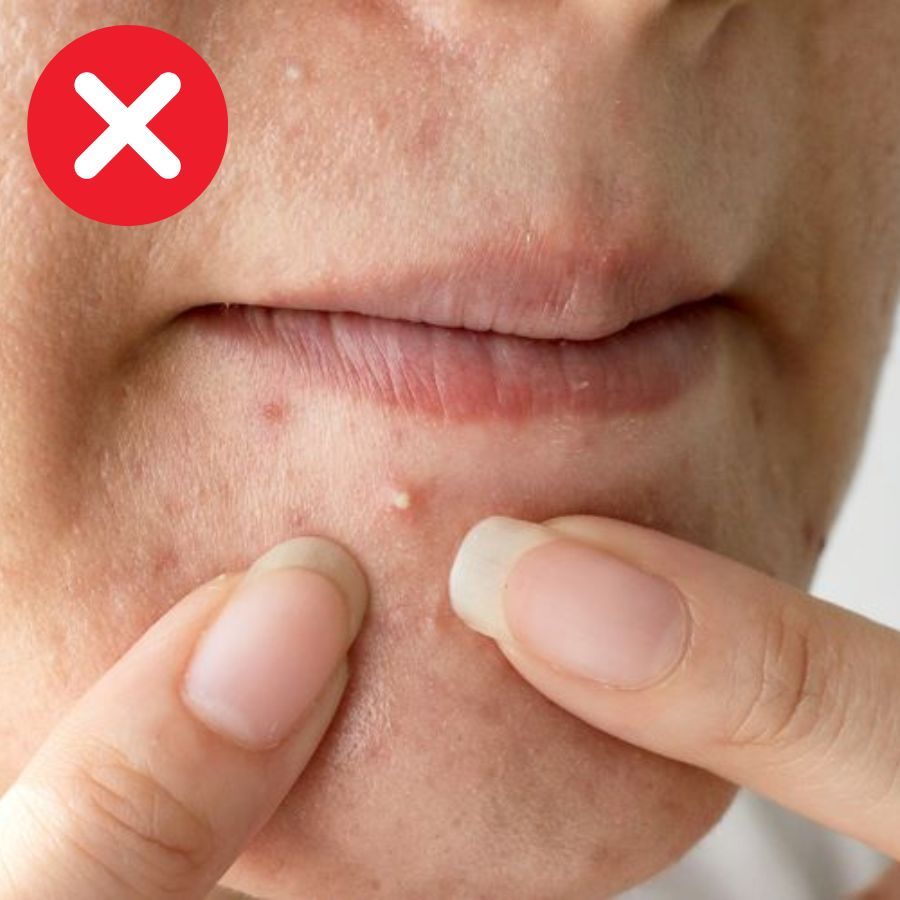 Cách xử lý nhanh nốt mụn chỉ sau 1 đêm - 4