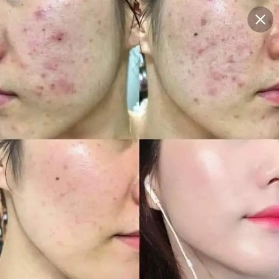 Cách xử lý nhanh nốt mụn chỉ sau 1 đêm - 5