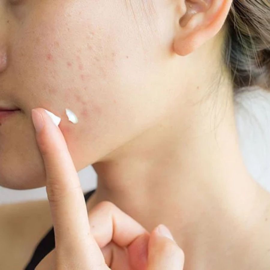 Cách xử lý nhanh nốt mụn chỉ sau 1 đêm - 9